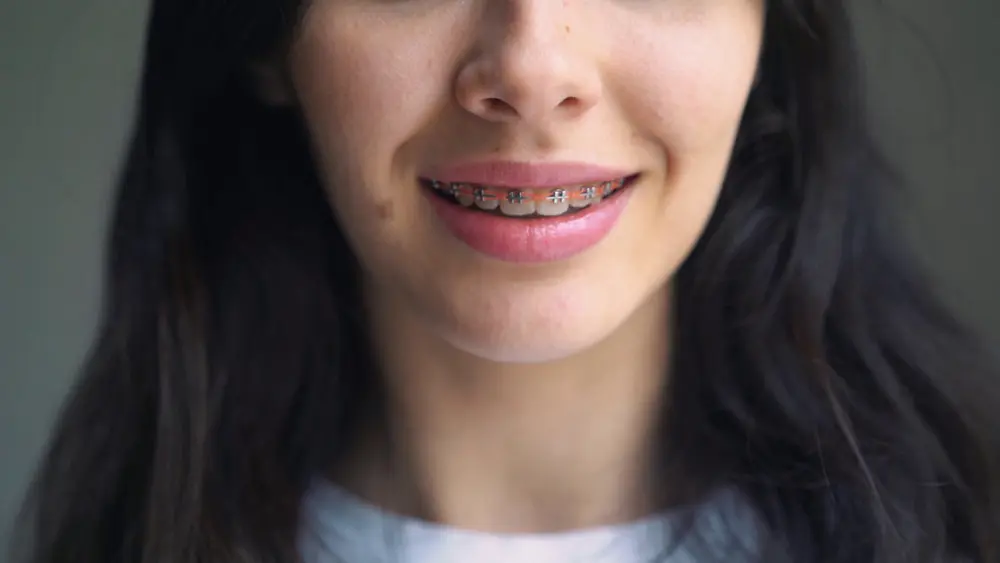 traditional metal braces