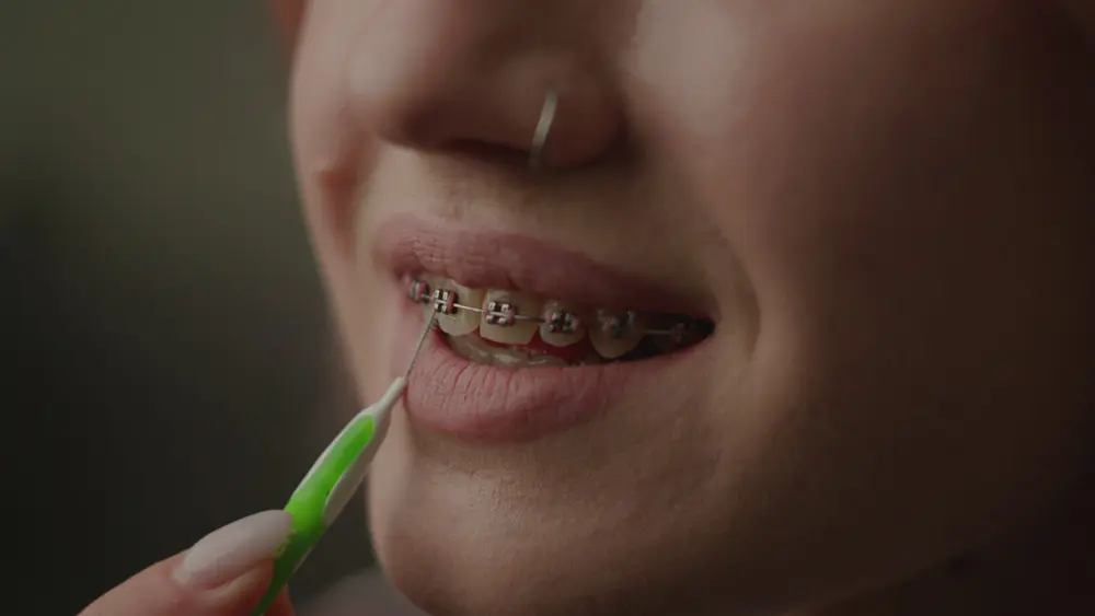traditional metal braces