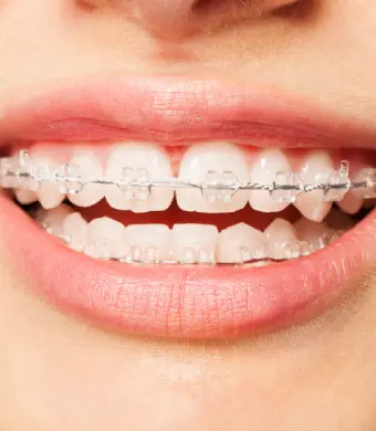 Ceramic Braces