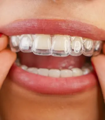 Clear Aligners