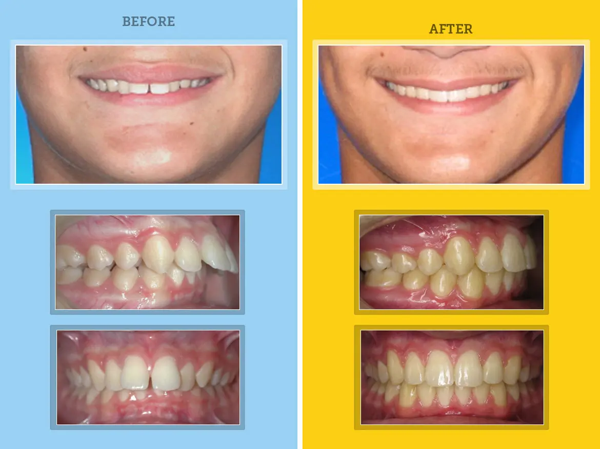 orthodontic results