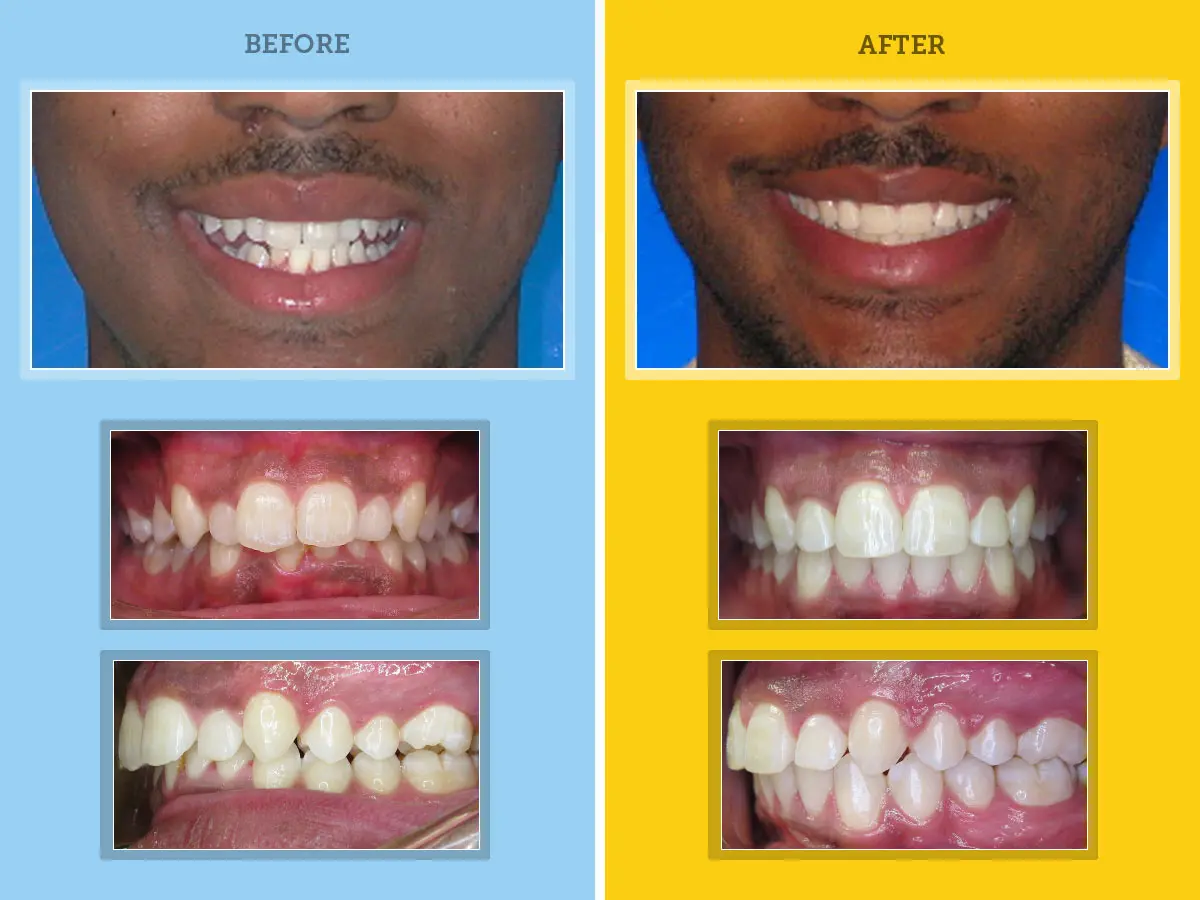 orthodontic results