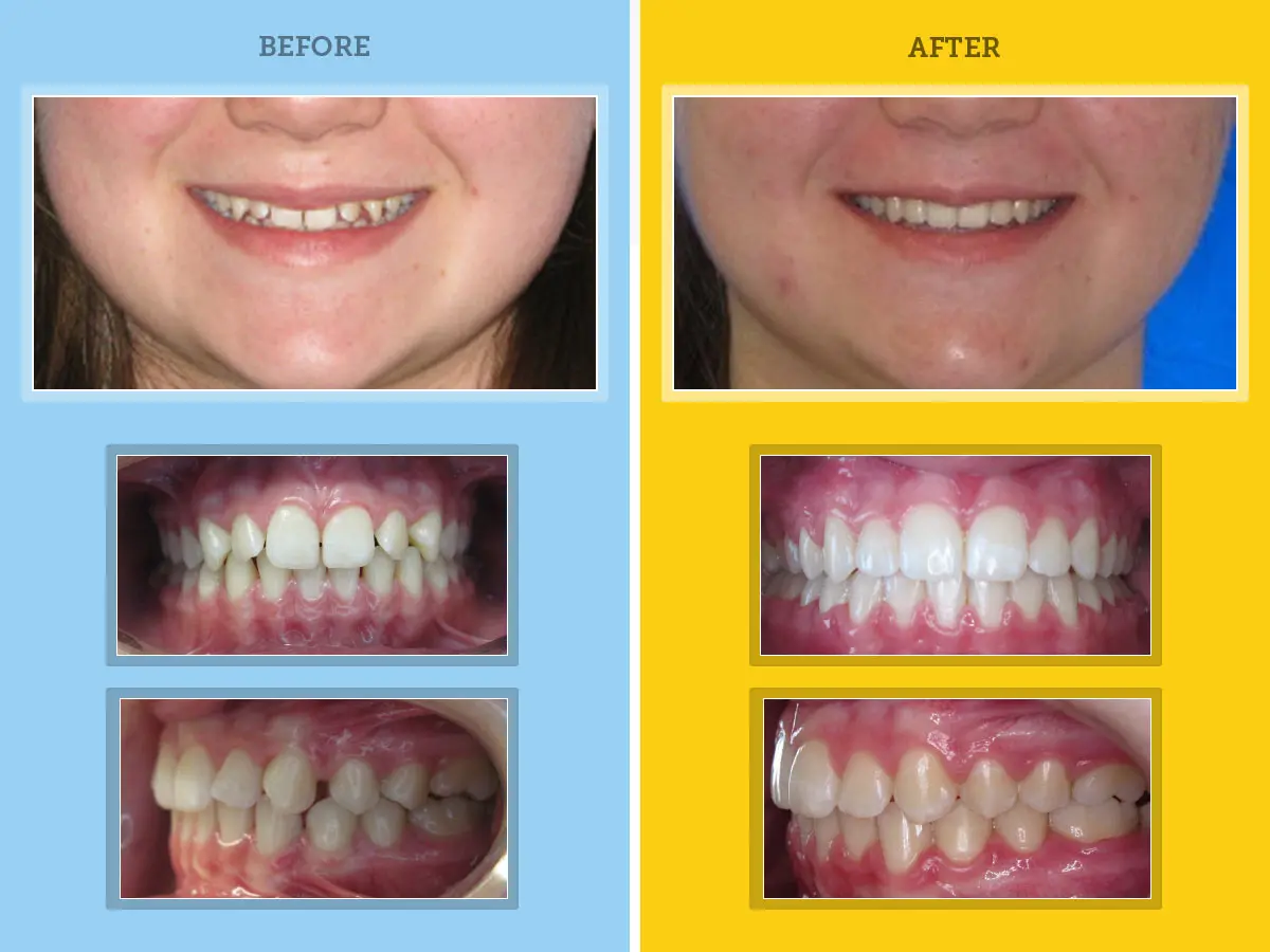 orthodontic results