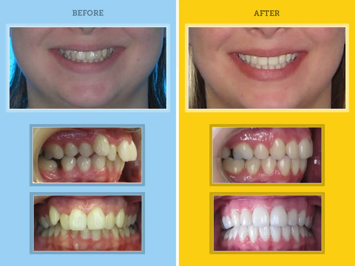 orthodontic results