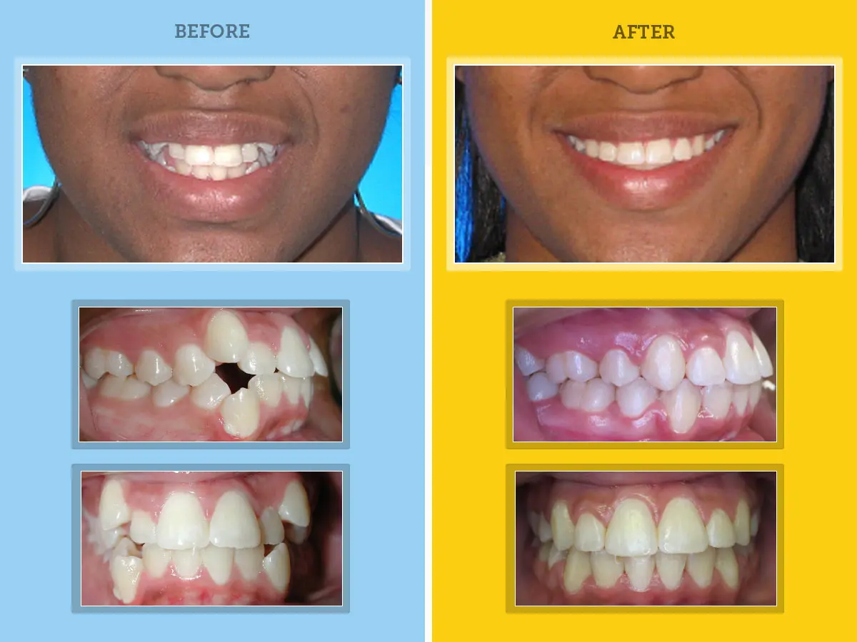 orthodontic results