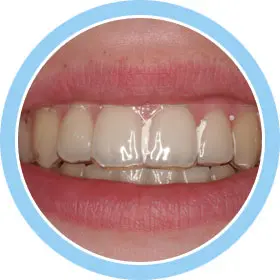 orthodontic retainers
