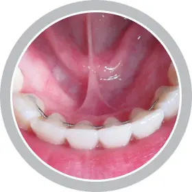 orthodontic retainers