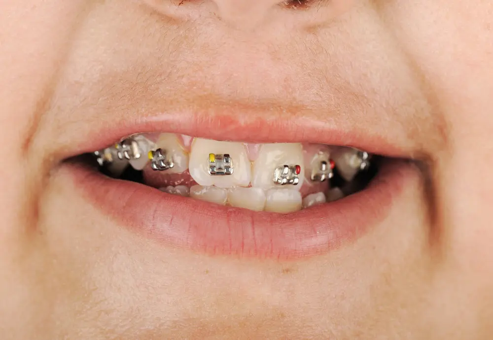traditional metal braces