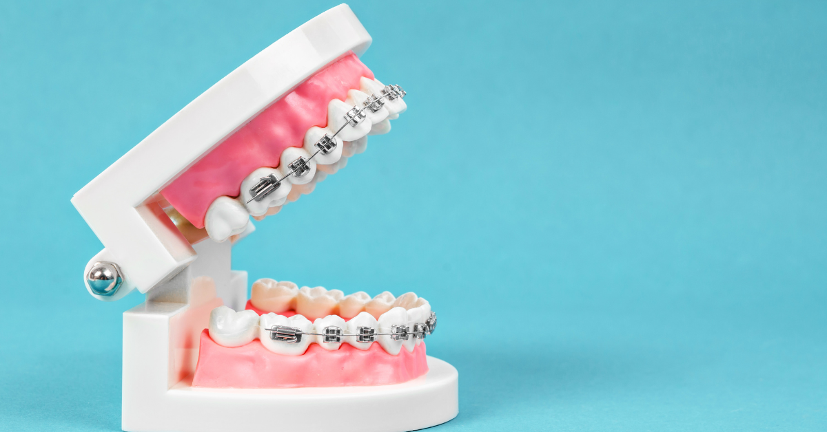 How to Get Braces Covered by Medical Insurance - Smile Brite