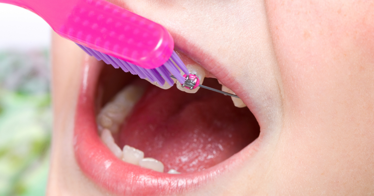 How to Choose the Best Solution for Your Missing Teeth