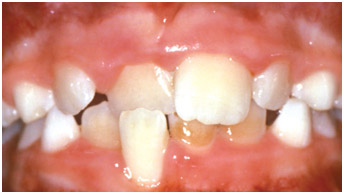 example-teeth1