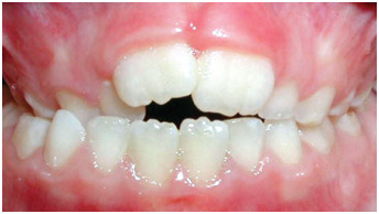 example-teeth2