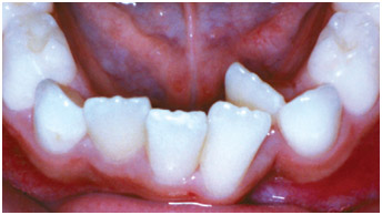 example-teeth3