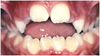 example-teeth4