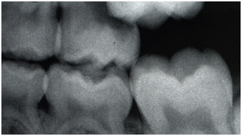 example-teeth6