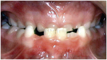 example-teeth7