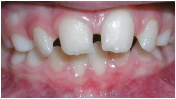 example-teeth8