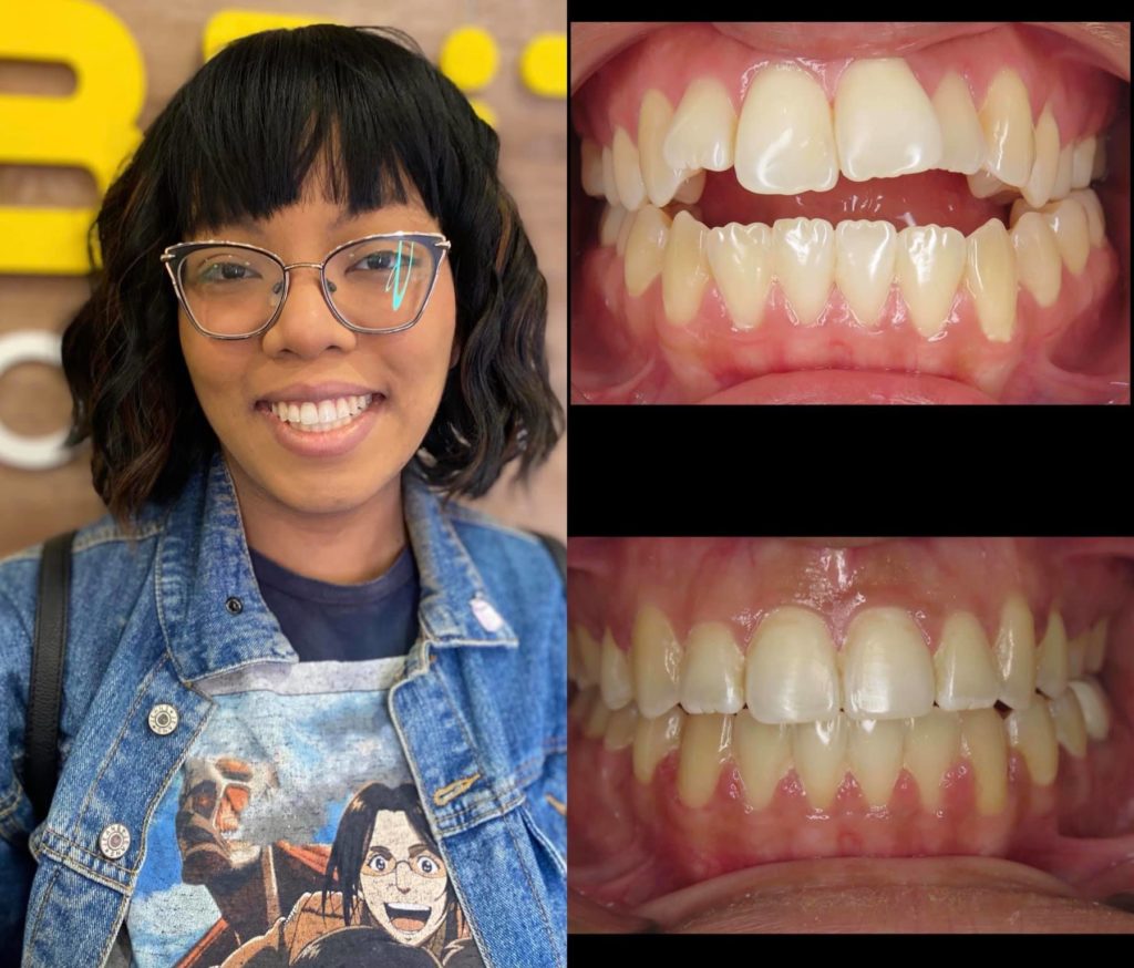 Smile Brite Orthodontics - Before and after