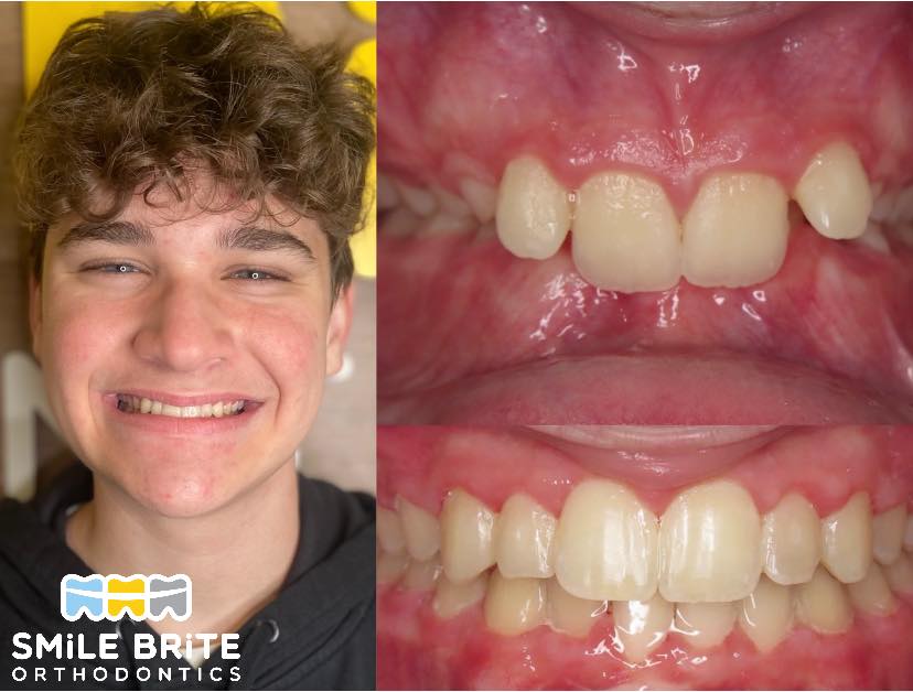 Smile Brite Orthodontics - Before and after