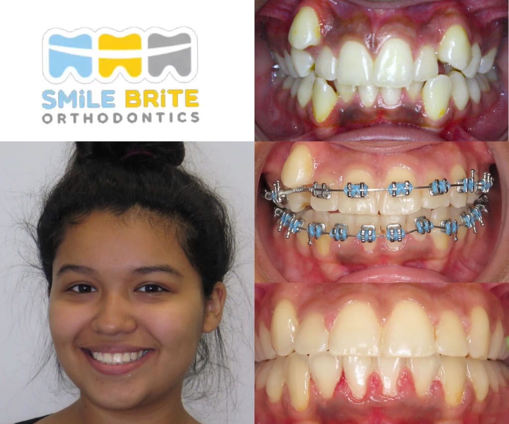 Smile Brite Orthodontics - Before and after