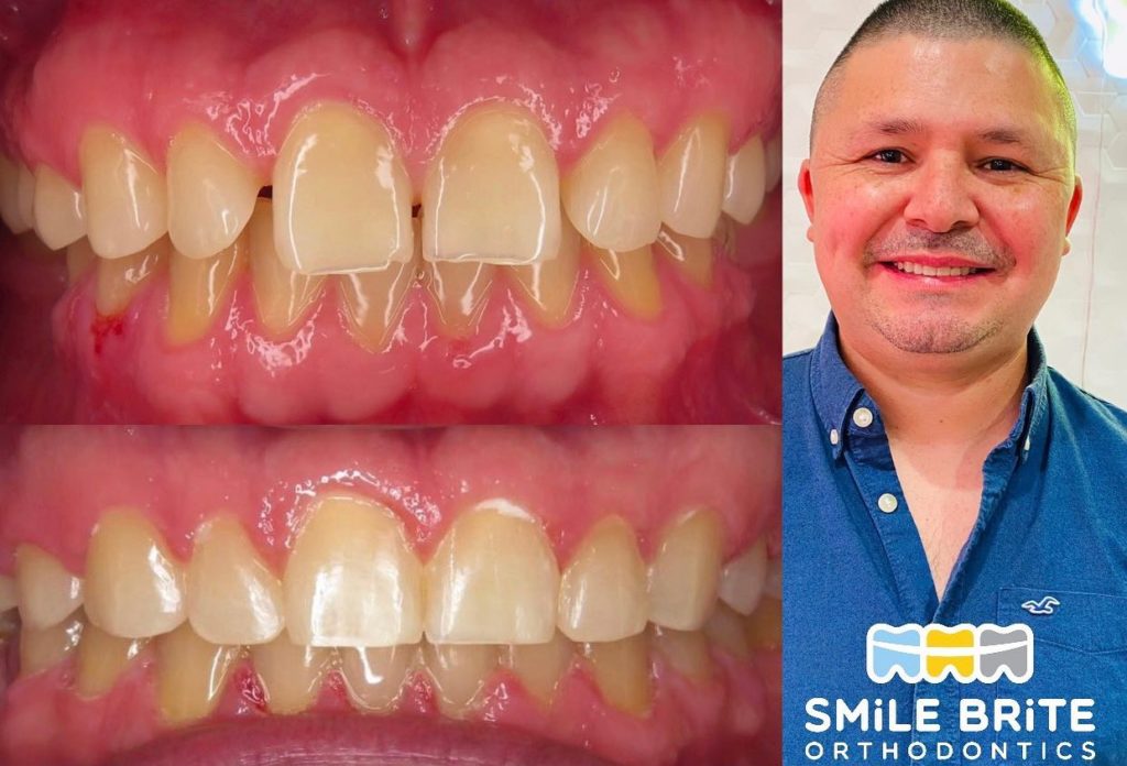 Smile Brite Orthodontics - Before and after