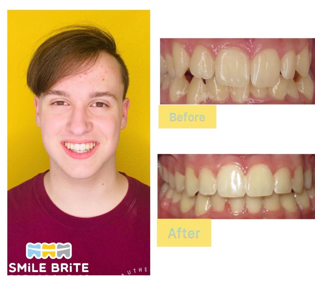 Smile Brite Orthodontics - Before and after