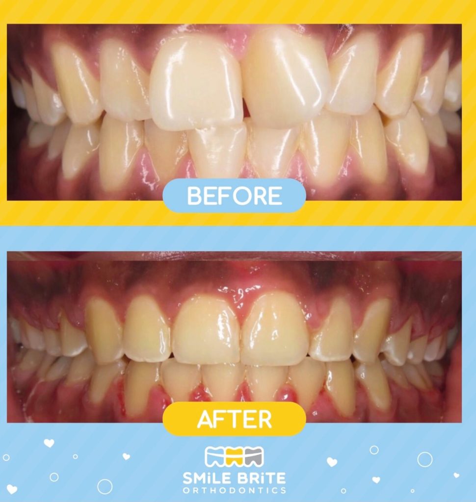 Smile Brite Orthodontics - Before and after
