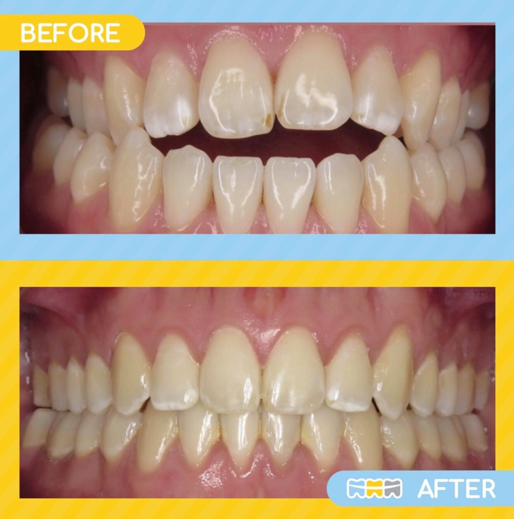 Smile Brite Orthodontics - Before and after