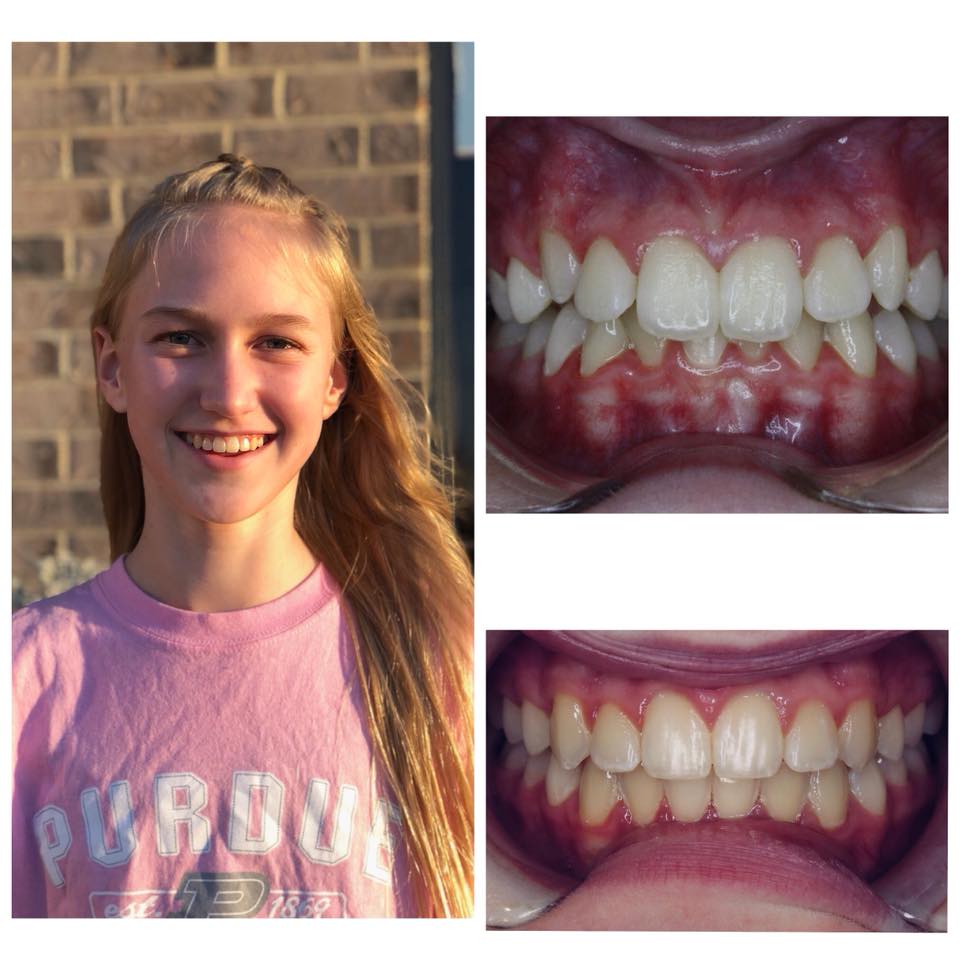 Smile Brite Orthodontics - Before and after