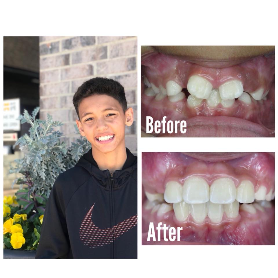 Smile Brite Orthodontics - Before and after