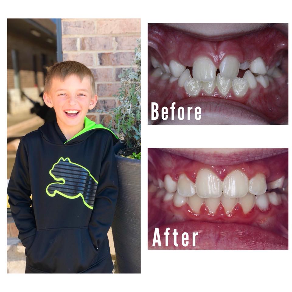 Smile Brite Orthodontics - Before and after