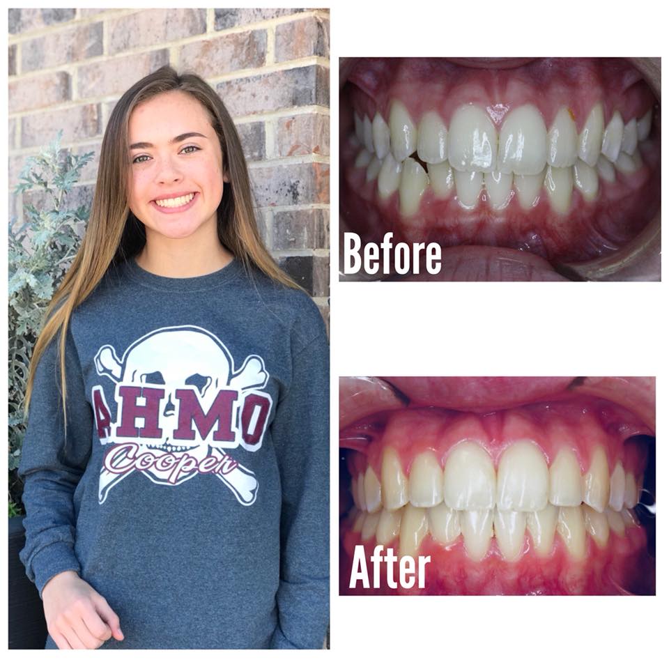 Smile Brite Orthodontics - Before and after