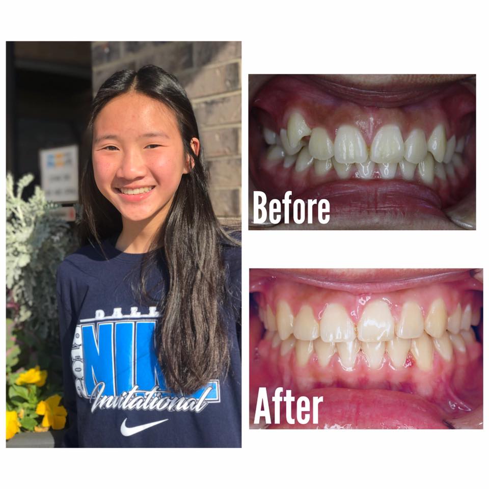 Smile Brite Orthodontics - Before and after