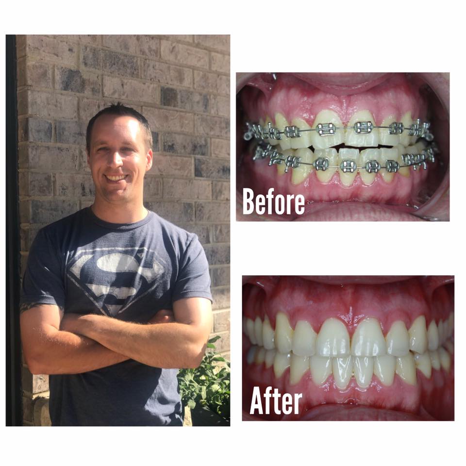 Smile Brite Orthodontics - Before and after