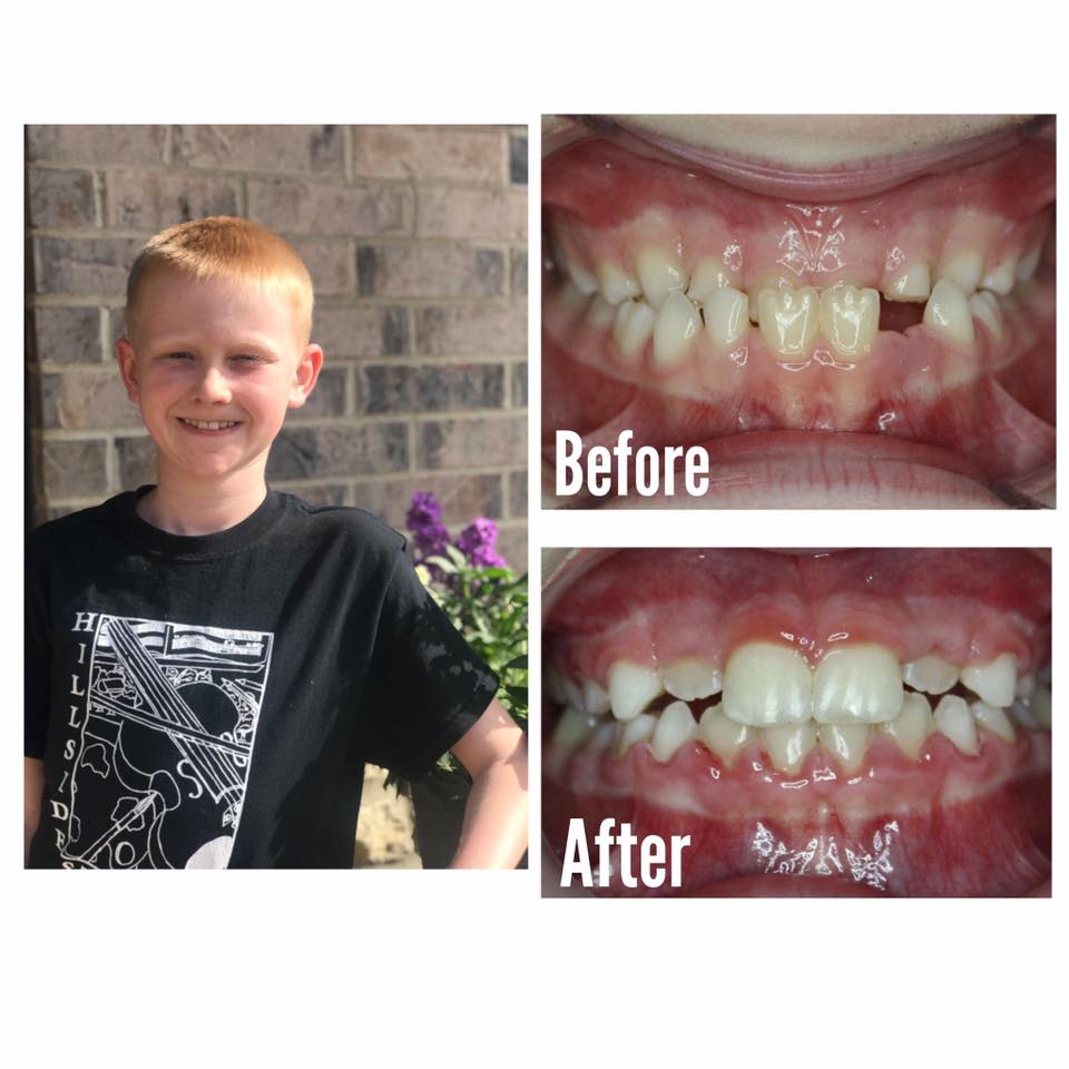 Smile Brite Orthodontics - Before and after