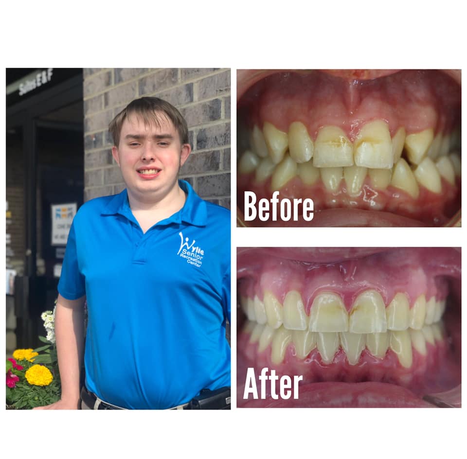 Smile Brite Orthodontics - Before and after
