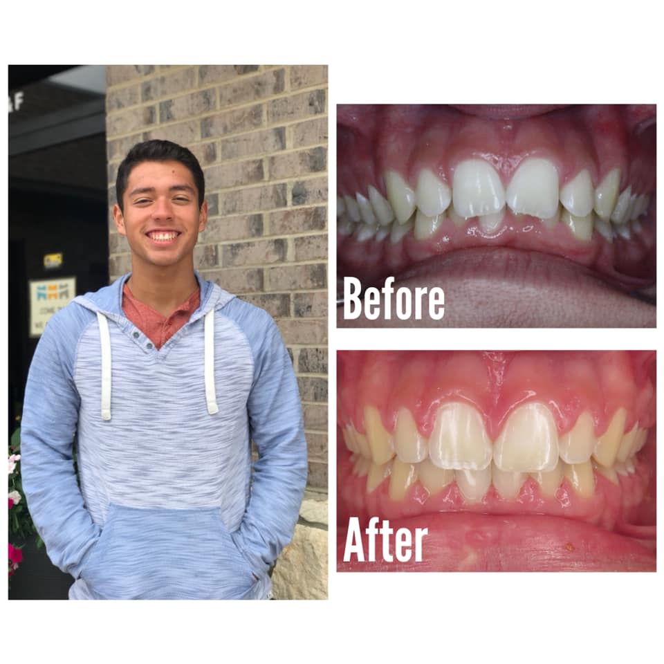 Smile Brite Orthodontics - Before and after