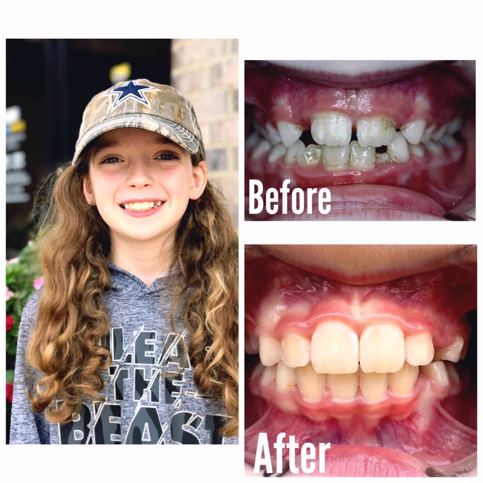 Smile Brite Orthodontics - Before and after