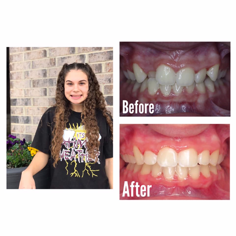 Smile Brite Orthodontics - Before and after