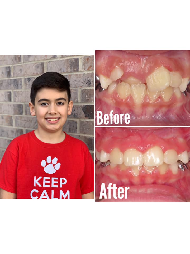 Smile Brite Orthodontics - Before and after