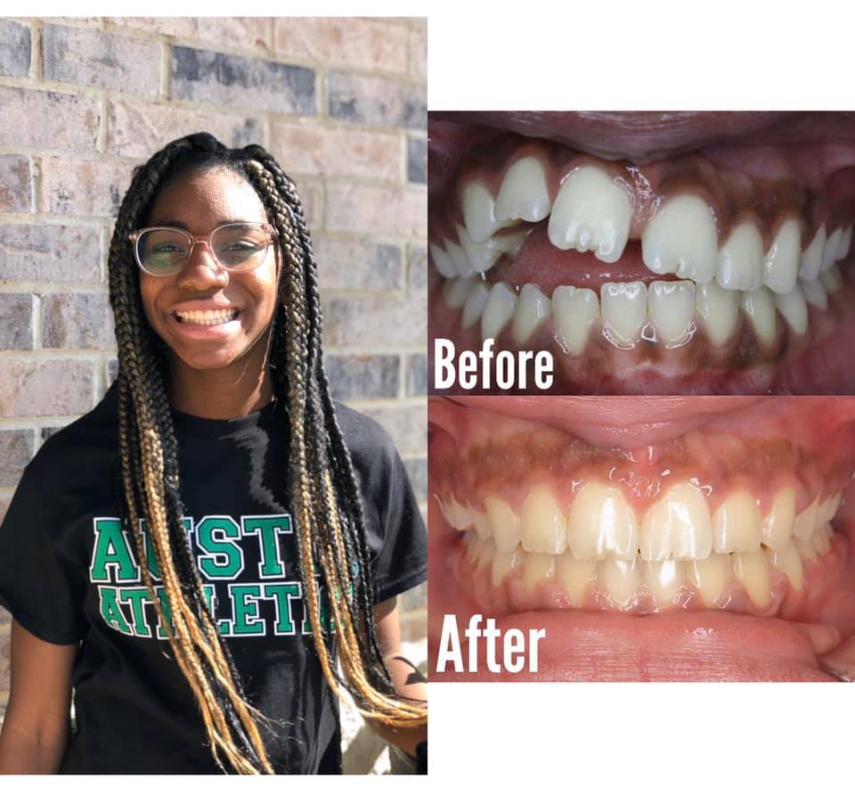Smile Brite Orthodontics - Before and after