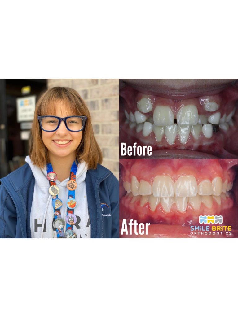 Smile Brite Orthodontics - Before and after
