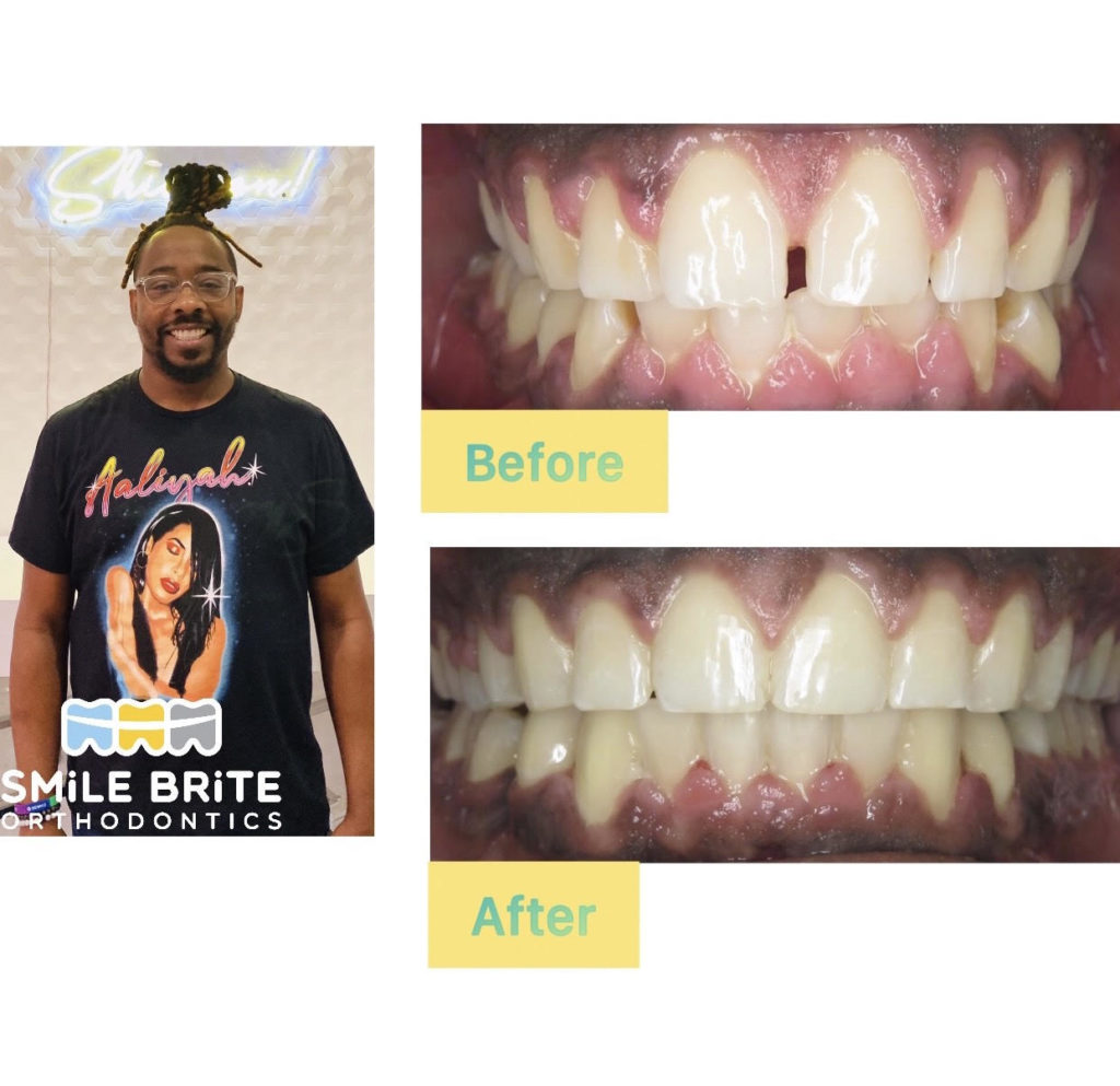 Smile Brite Orthodontics - Before and after