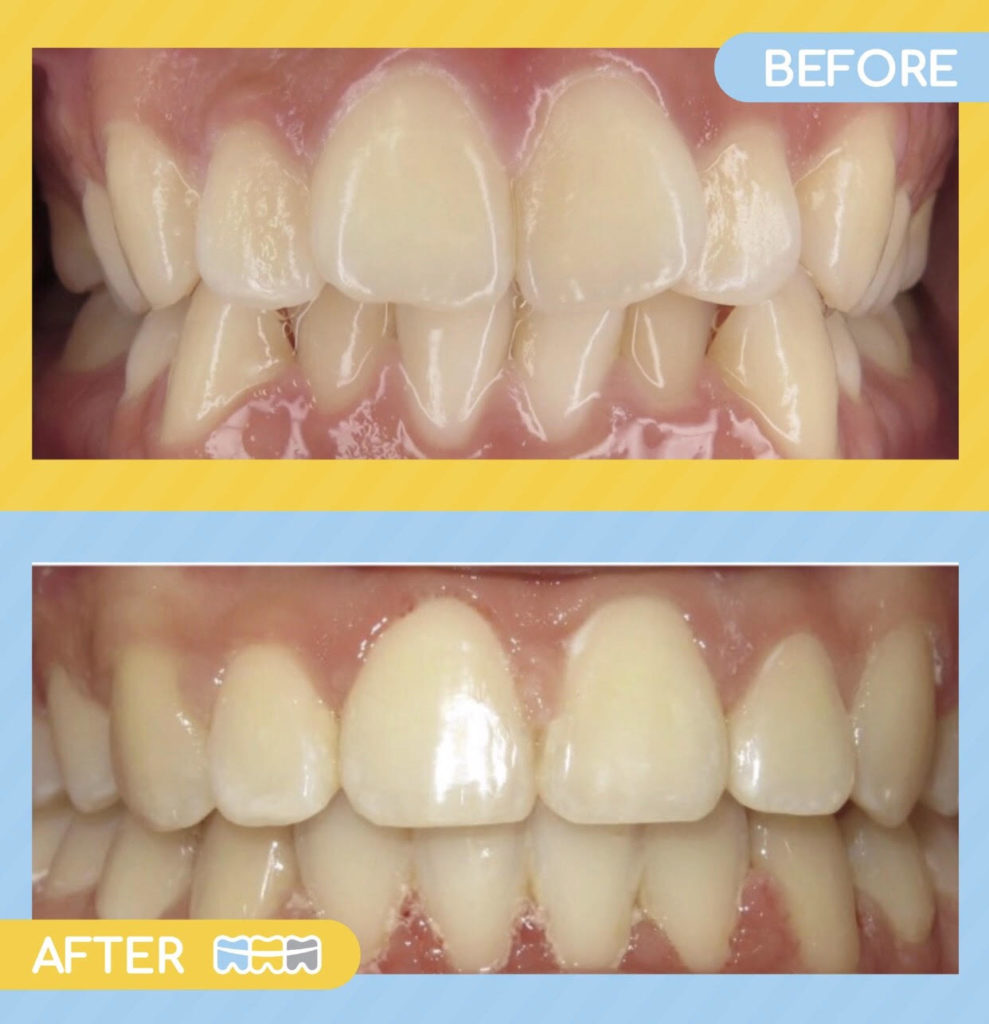 Smile Brite Orthodontics - Before and after