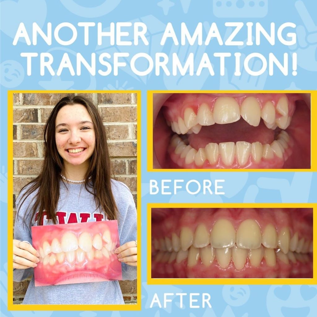 Smile Brite Orthodontics - Before and after