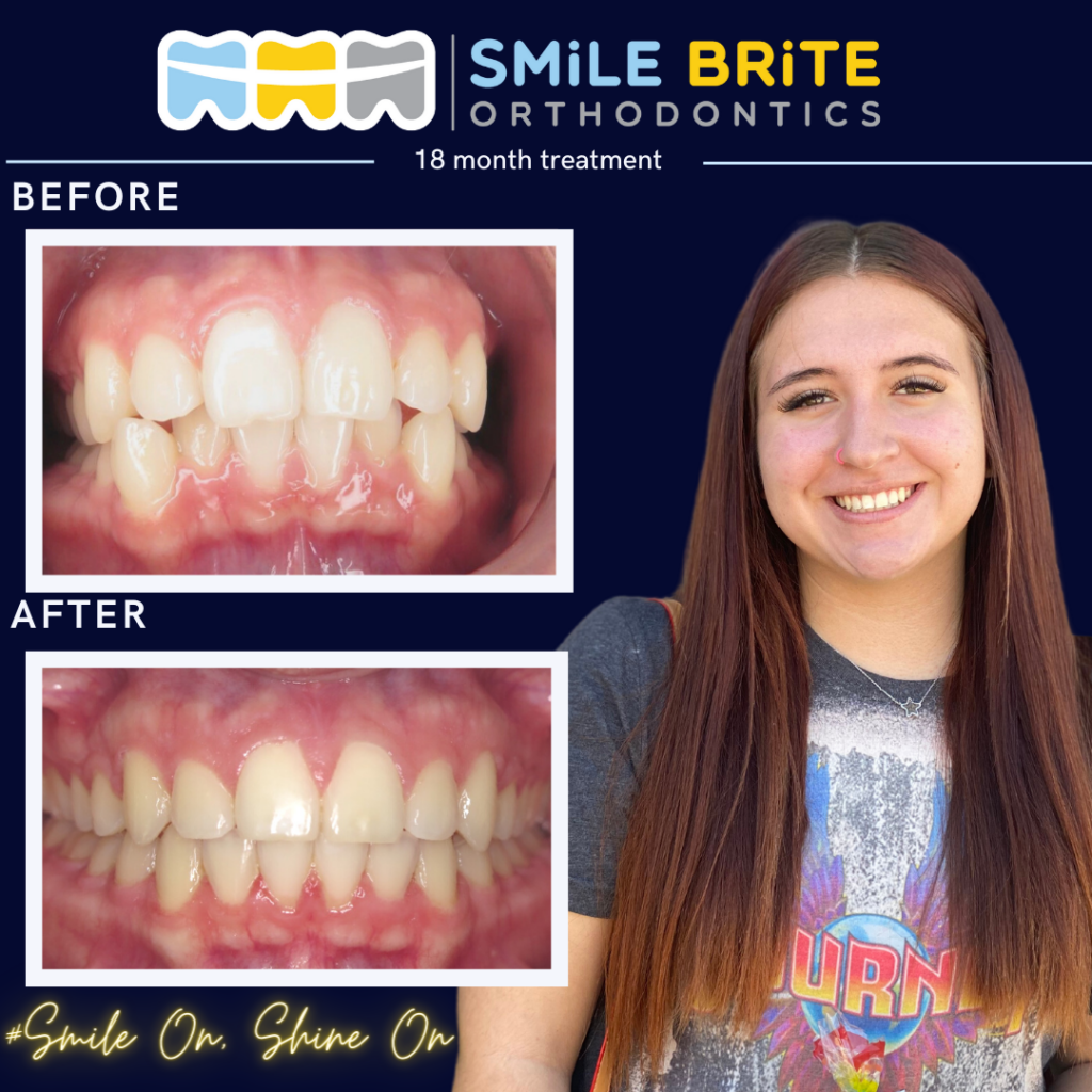 Smile Brite Orthodontics - 18 month treatment