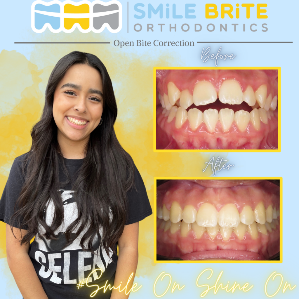 Smile Brite Orthodontics - Open bite correction