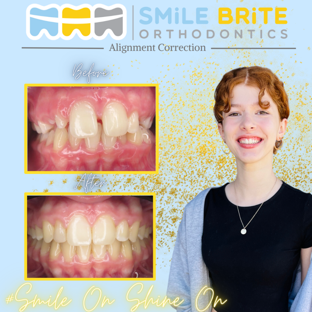 Smile Brite Orthodontics - Alignment Correction
