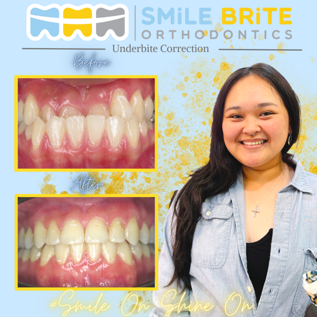 Smile Brite Orthodontics - Underbite Correction