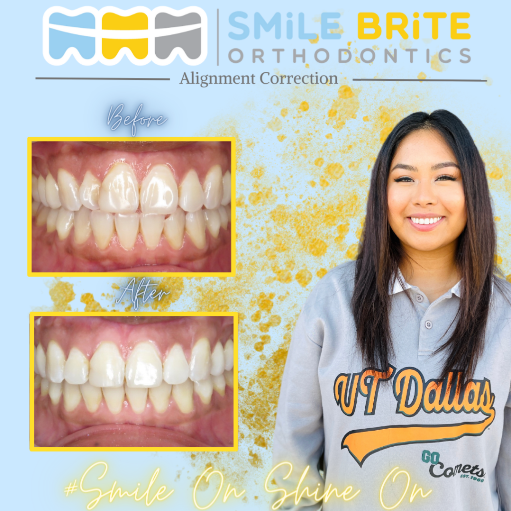 Smile Brite Orthodontics - Alignment Correction